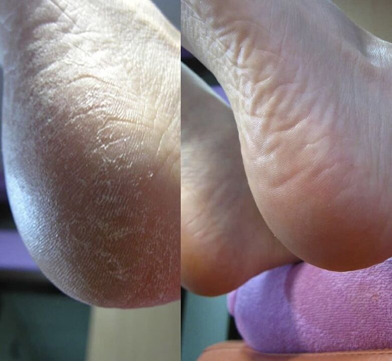 Photo du talon du pied avant et après utilisation de la crème Zenidol