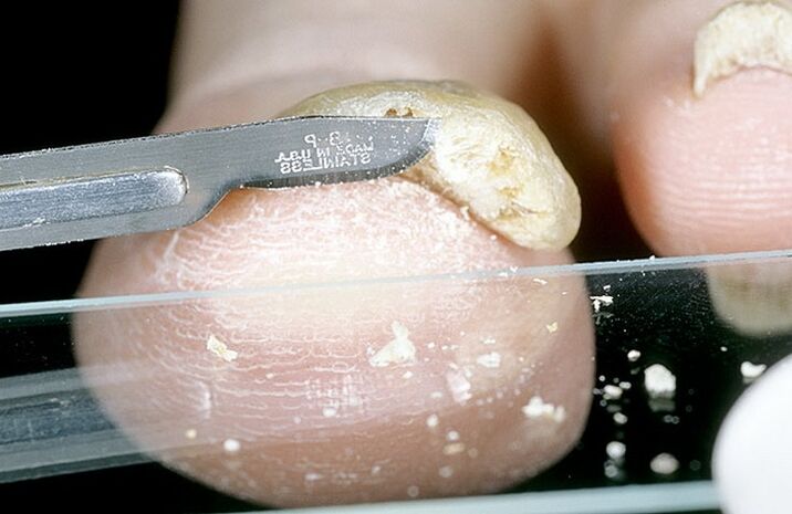 gratter les ongles pour diagnostiquer les champignons