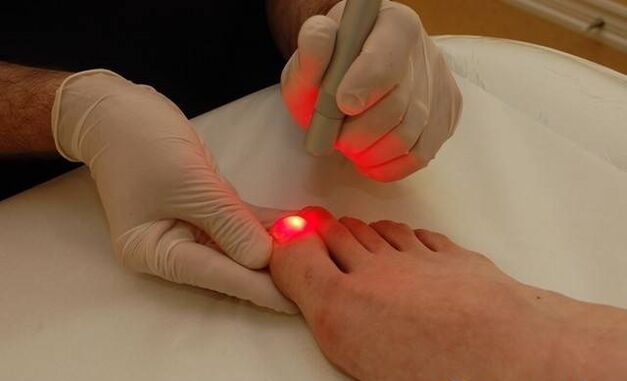 traitement au laser pour mycose des ongles