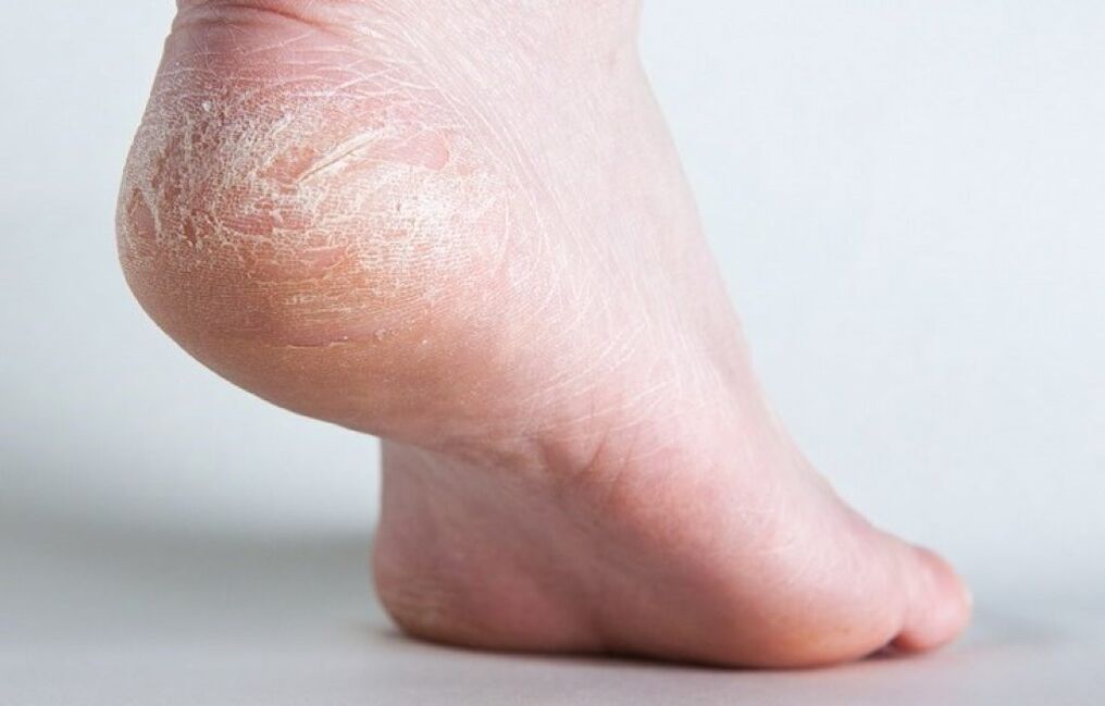 champignon de la peau des jambes comment traiter