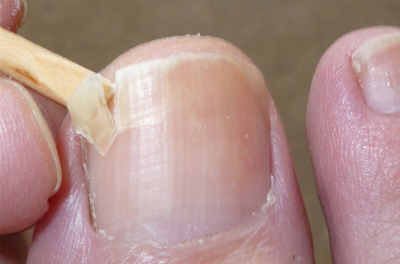 Les ongles abîmés sont un facteur de risque d'infection fongique