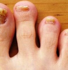 Le pied de la nog