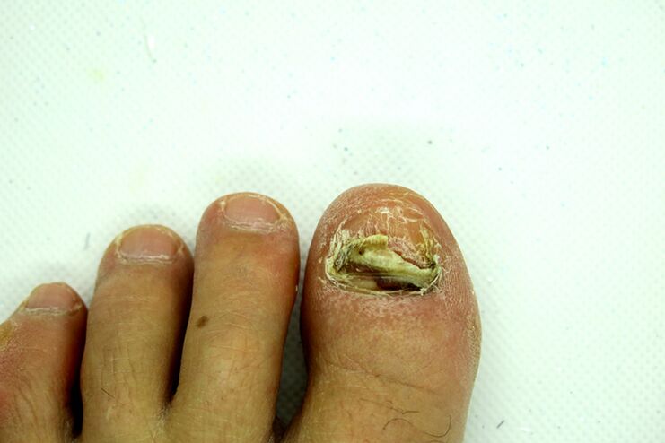Fungus Finger - Stage lourd