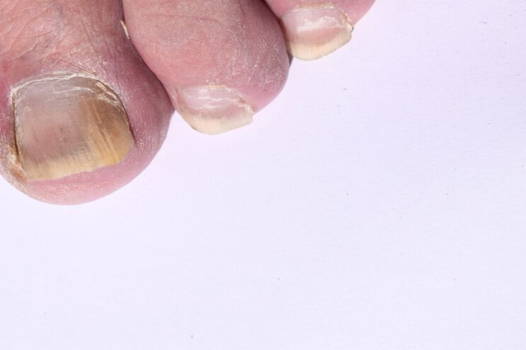 Le stade initial de la mycose des clous sur les jambes