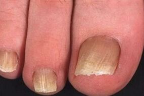 infection fongique des ongles des pieds
