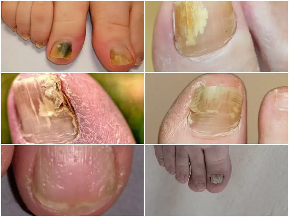 Les symptômes de l'onychomycose changent dans la couleur et la structure des ongles.