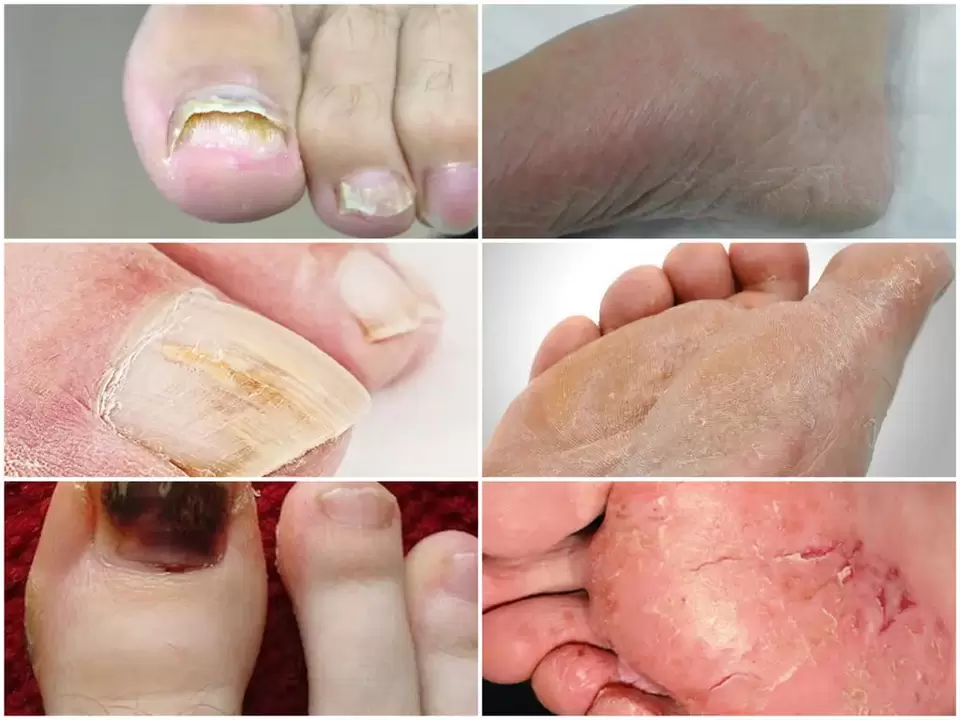 Manifestations de champignons du pied dues à divers agents pathogènes.