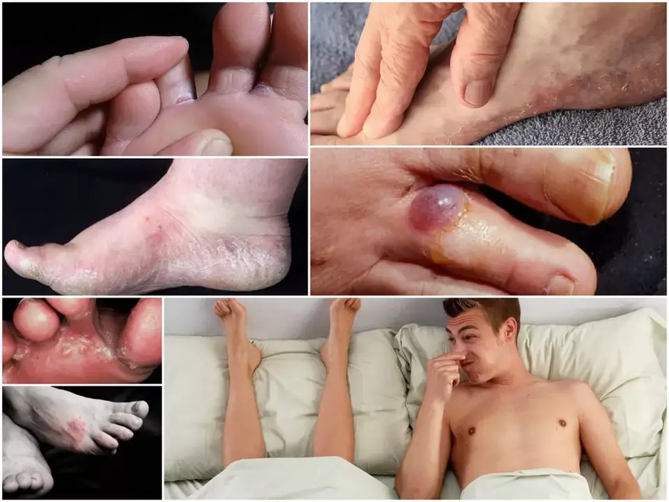 Principaux signes de mycose du pied.