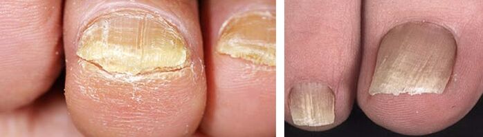 dommages aux ongles avec une infection fongique