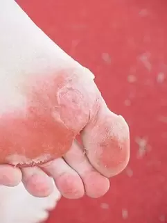 symptômes de mycose des pieds